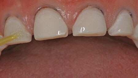 在修復體的凹陷面和牙齒上塗上一層薄薄的3M™ Singlebond™ Universal Adhesive。