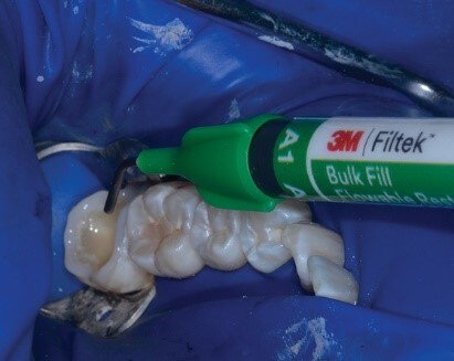 塗抹3M™ Singlebond™ Universal通用黏著劑