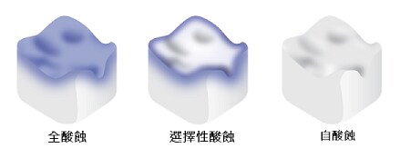 齒科酸蝕方式：全酸蝕、選擇性酸蝕、自酸蝕