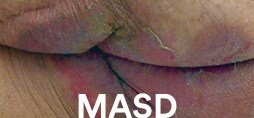 潮濕性相關皮膚損傷 (MASD)