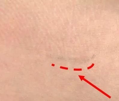 殘膠與衣物纖維在皮膚上形成的深色殘膠痕跡