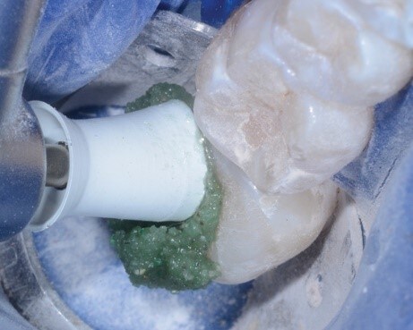 使用Magic Mix (Bioclear®)
