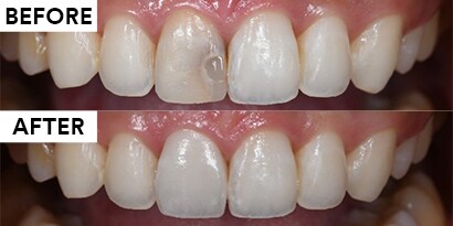 臨床案例分享-單顆正中門齒3MLAVA全瓷牙冠美學修復