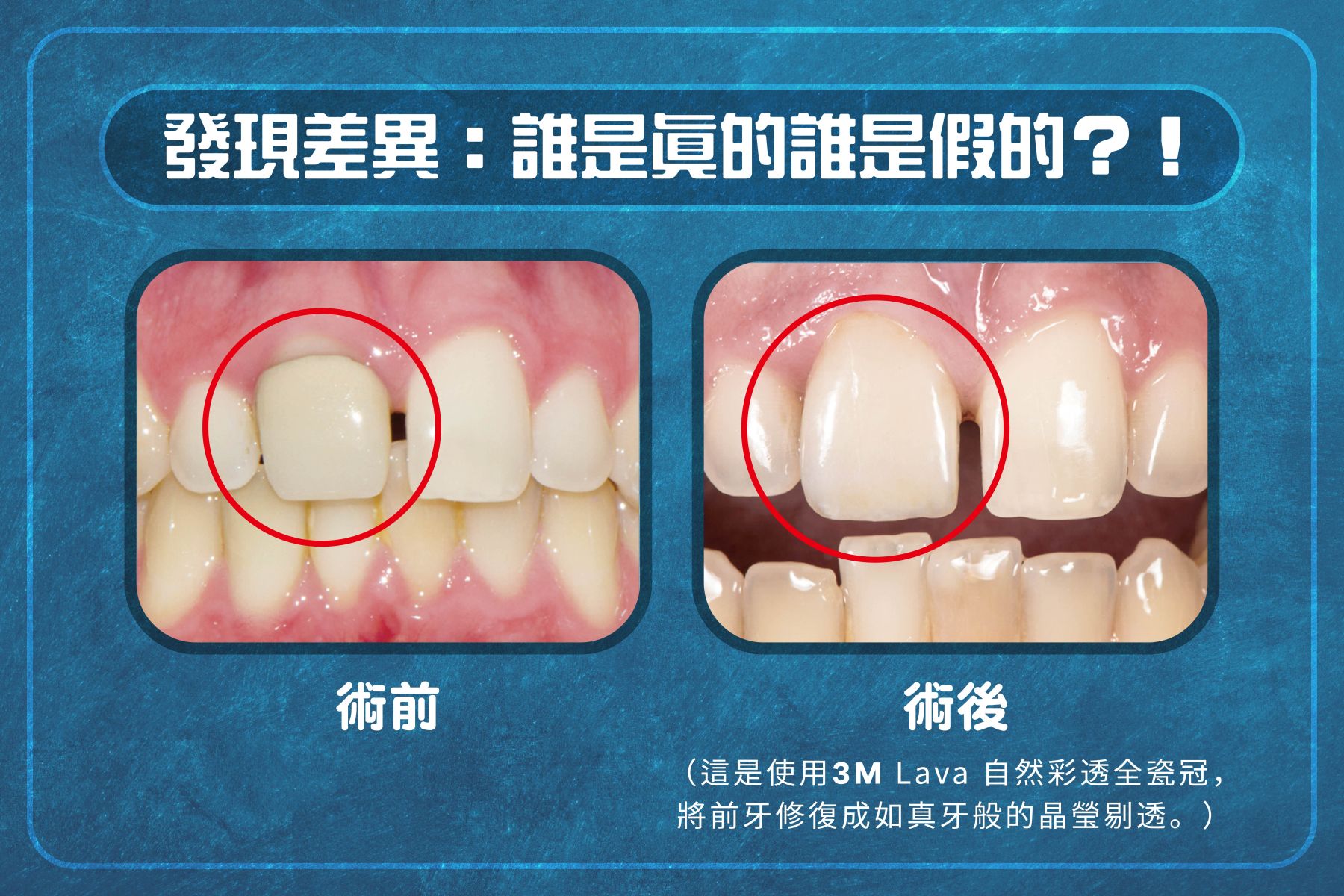 我適合全瓷冠假牙嗎？