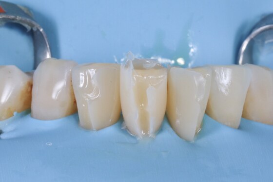 使⽤3M™ Filtek™ Supreme Flowable 做injection molding technique填補