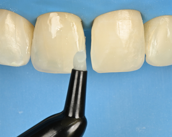 使用3M™ Filtek™ Z350xt Universal Restorative（Shade A1E）。