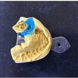 金屬牙托取模