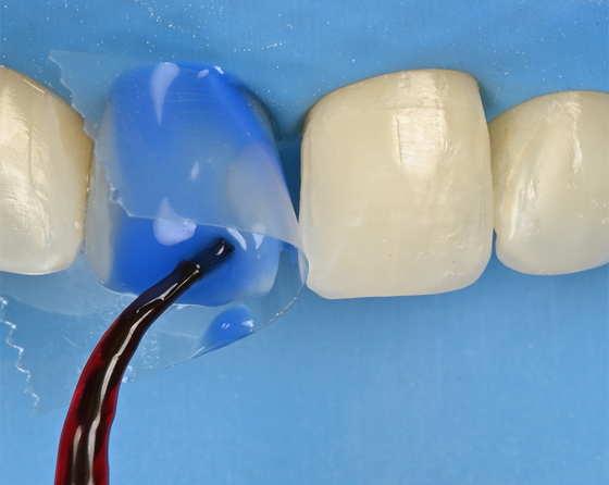 使用酸蝕劑後，用3M™ Singlebond™ Universal 黏著劑 並進行光固化。