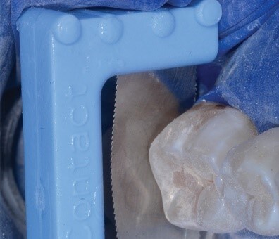 使用TruContact Saw (Bioclear®)