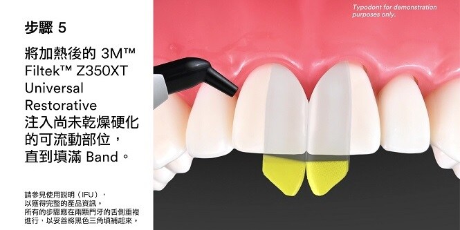 Bioclear黑色三角填補示範
