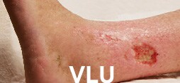下肢靜脈性潰瘍 (VLU)