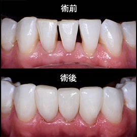 牙齒黑三角的填補方案