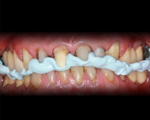 3M™ Imprint™ 4 Bite VPS 咬合記錄。