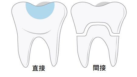 齒科直接修復與間接修復的差異