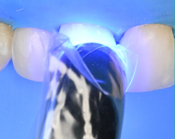 使用3M™ Elipar™ DeepCure-L LED光固化燈對所有表面進行光固化。