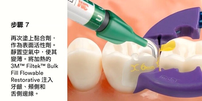 Bioclear後牙修復示範
