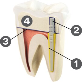 A simple solution for a complex procedure