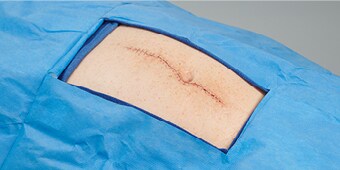 Surgical incision
