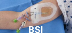 血流感染(BSI)