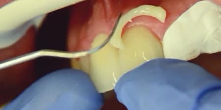 易於清理多餘的部分
