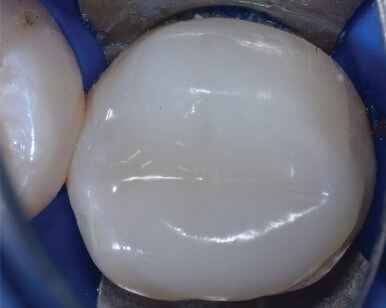 3M™ Filtek™ One大窩洞動充填樹脂