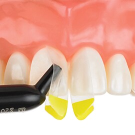 3M Filtek Restorative 準備將複合材料注射到具有上顎模型的Bioclear 黑三角中。