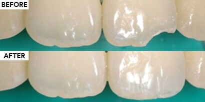 使用3M奈米樹脂補牙材料，進行門牙齲齒/缺損之治療