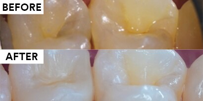 使用3M™ Filtek™ One Bulk Fill 配合Bioclear進行二級窩洞填補
