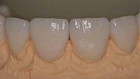 實驗室使用IPS e.max®（Ivoclar Vivadent）為上牙弓製作最終修復體。