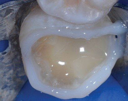 注入3M™ Filtek™大塊充填流動樹脂